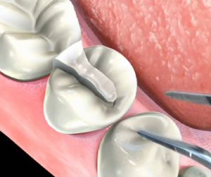 Link to more info about Porcelain And Composite Inlays