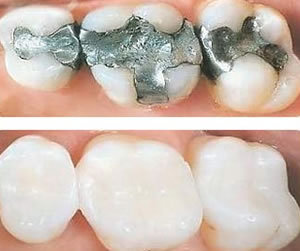 Link to more info about White Fillings