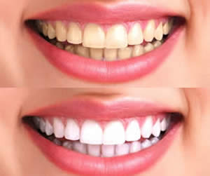 Link to more info about Teeth Whitening